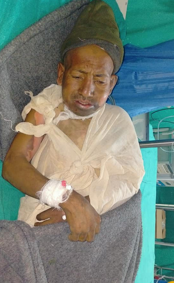 आगलागीबाट घाइते राउटे नारायणको मृत्यु